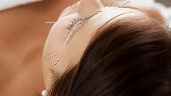中医针灸减肥效果好不好?中医针灸减肥要牢记这5大注意事项