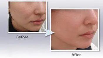 做像素激光费用花多少