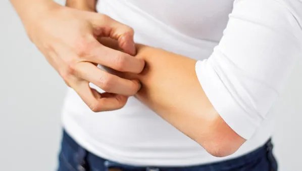 过敏性皮炎如何治疗