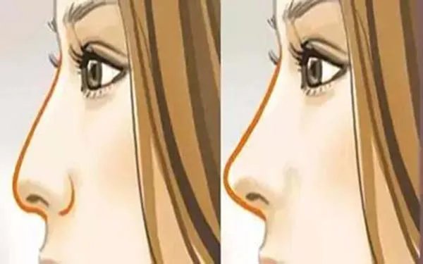 鼻部手术整形成都哪家医院好