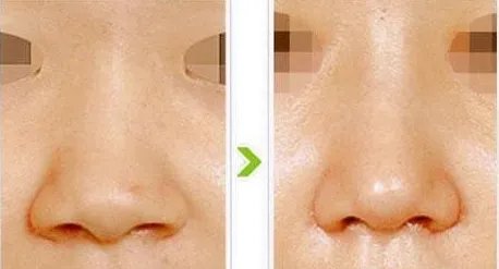 鼻翼缩小整形术价格大概多少