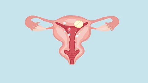 避孕环下移要怎么办