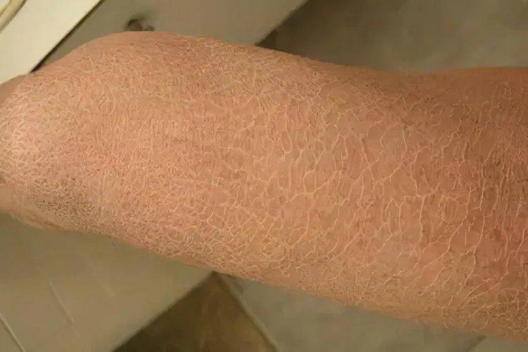 角质硬化症图片