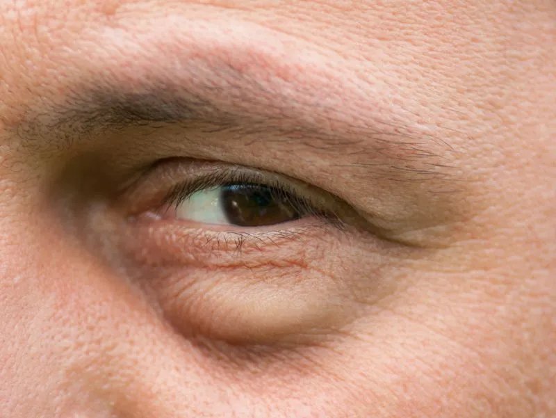 怎样快速去掉眼角纹