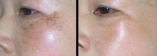 彩光嫩肤祛斑要多少钱