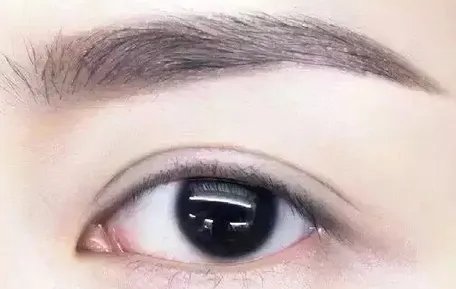 埋线双眼皮是永久的么