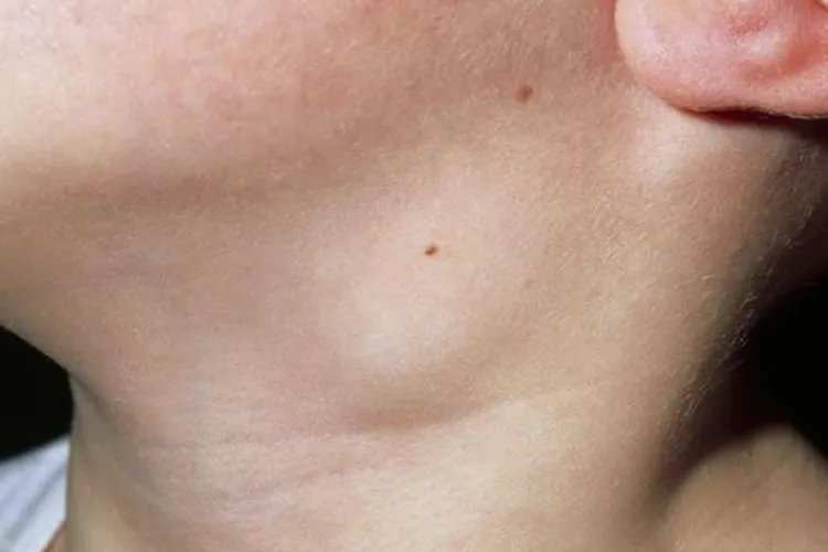 巴尔通体病图片