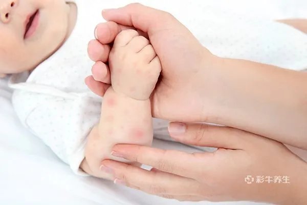 婴儿湿疹症状图片 婴儿湿疹的症状表现