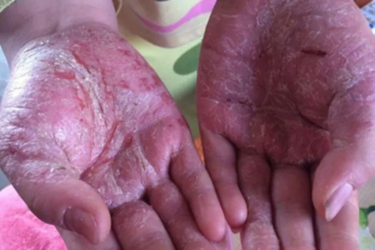 4级手足综合征脱屑图片