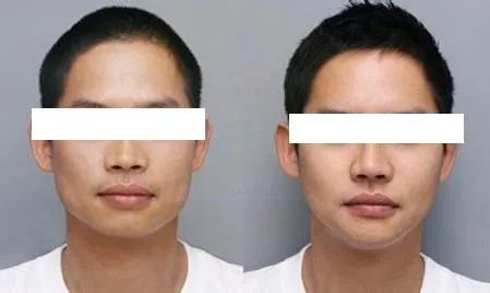 下颌骨削骨手术价格