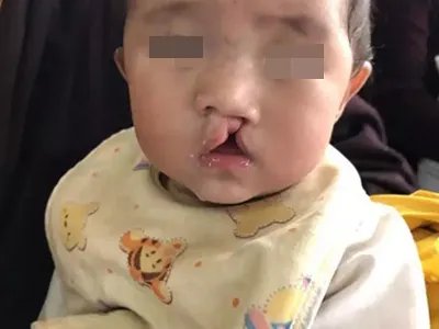 先天性风疹综合征症状图片