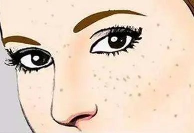 祛斑手术要多少钱