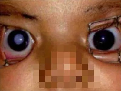 先天性风疹综合征症状图片