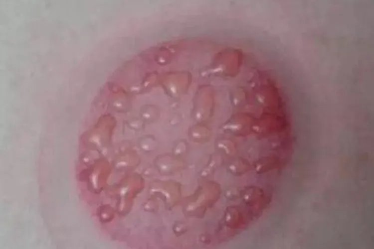 拔罐后皮肤颜色鉴别图片大全