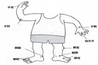 痛风一般发生在哪个位置图