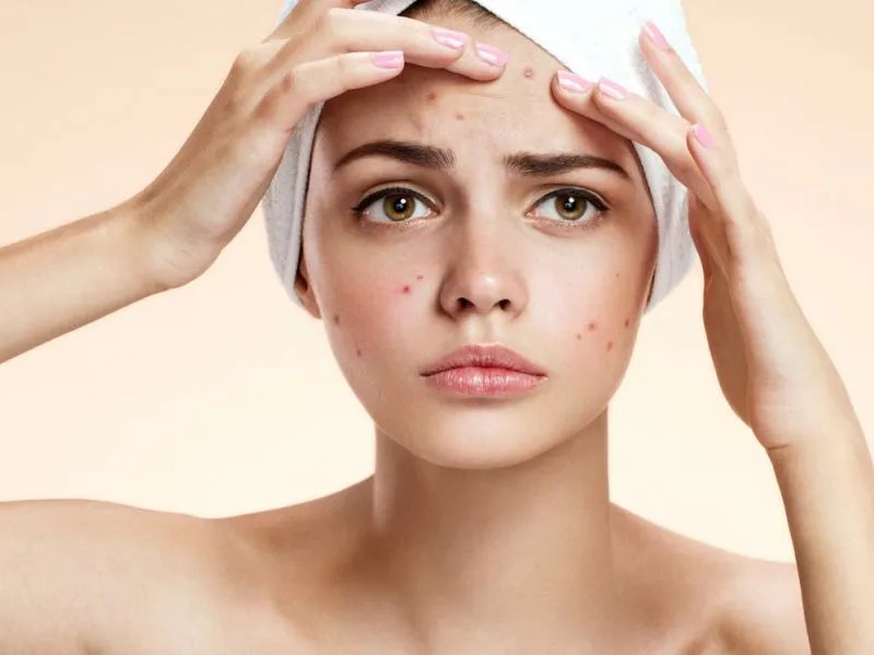 快速祛痘印的方法