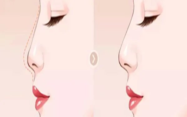 鼻部手术整形成都哪家医院好