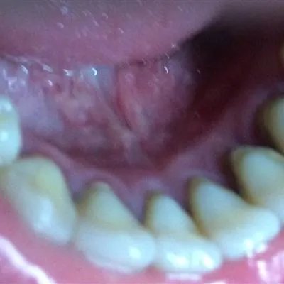 喝可乐腐蚀牙齿吗