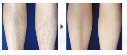 深圳永久性激光脱毛价格到底是多少