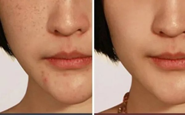 雀斑可以去掉吗