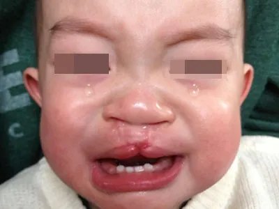 先天性风疹综合征症状图片