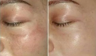 激光美容祛斑手术效果好吗