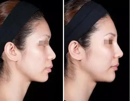 玻尿酸隆鼻能保持多久