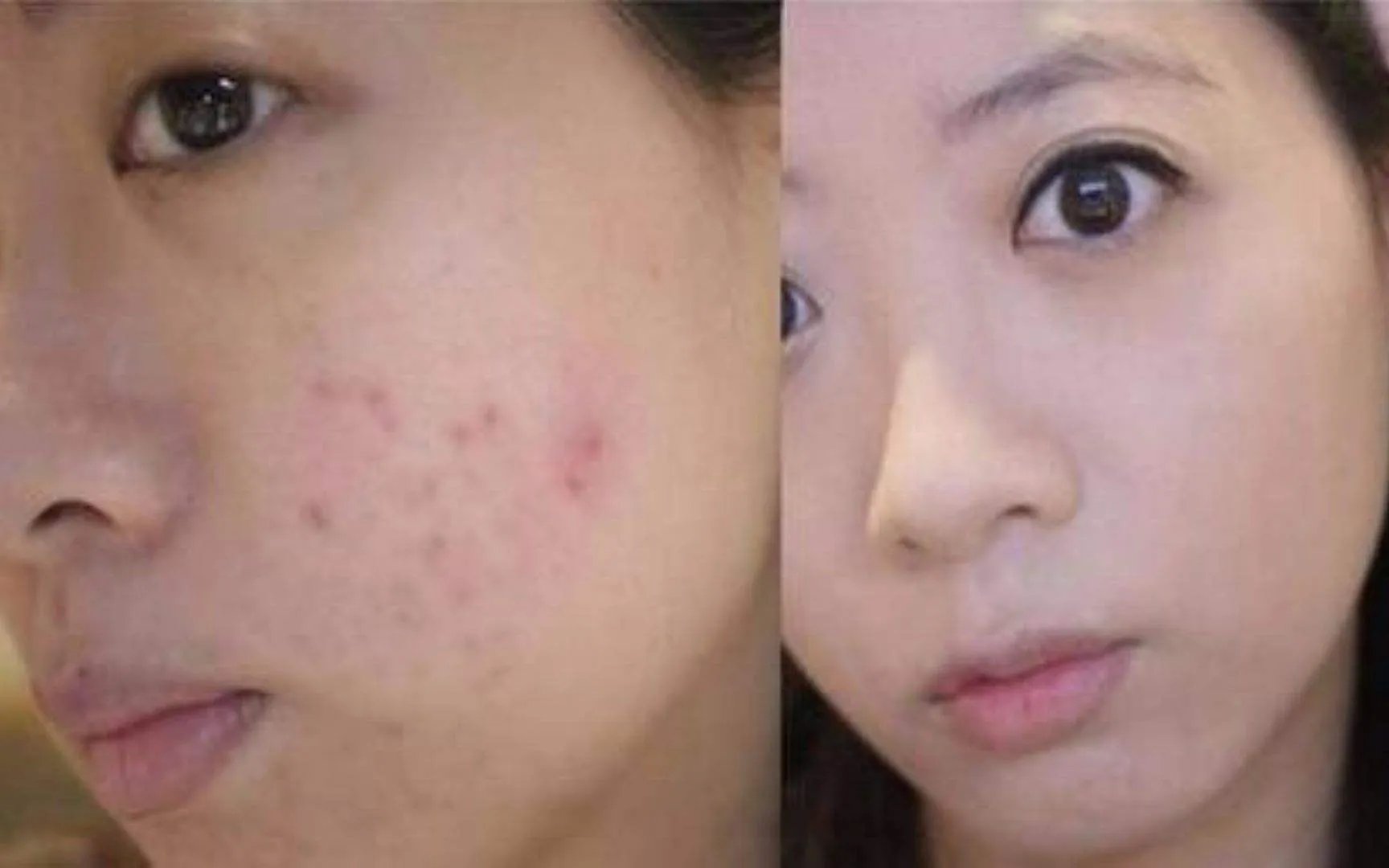 激光痤疮要多少钱