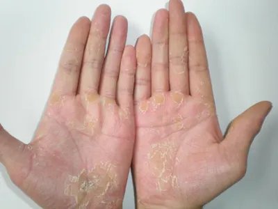 表皮松解性掌跖角皮症手掌皮肤增厚图片