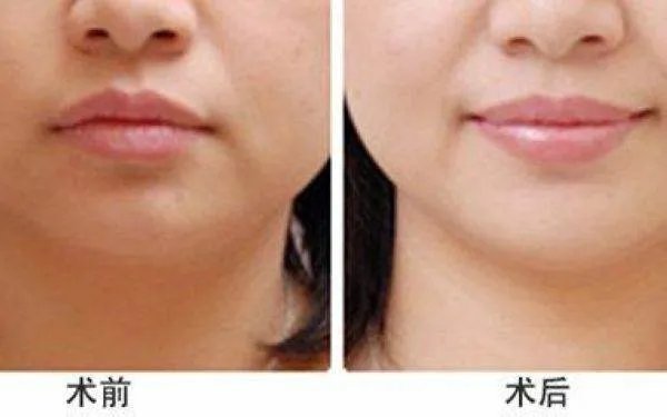 嘴唇整形需要多少钱