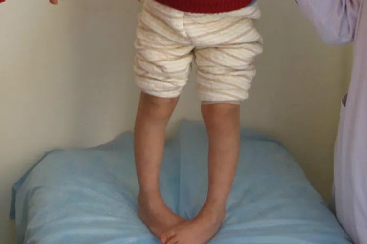 脑瘫的症状图片