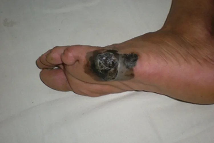 肢端雀斑痣样黑素瘤出现疙瘩图片