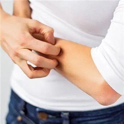 如何治疗牛皮癣