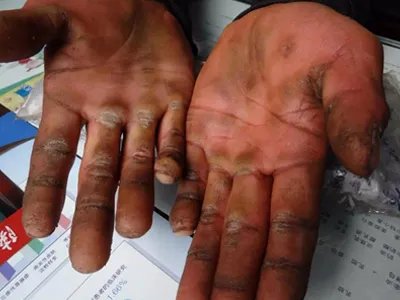 表皮松解性掌跖角皮症手掌皮肤增厚图片