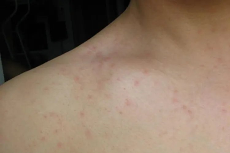 轻型麻疹症状图片