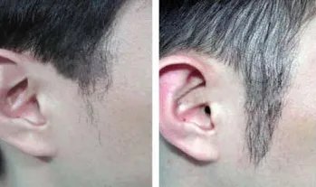 鬓角移植是什么