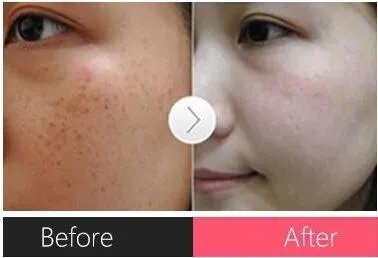 彩光祛斑效果好吗