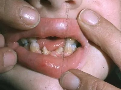 先天性外胚叶发育不良缺损图片