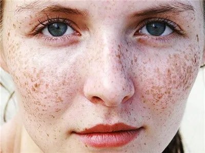 生活中常用祛斑的小窍门