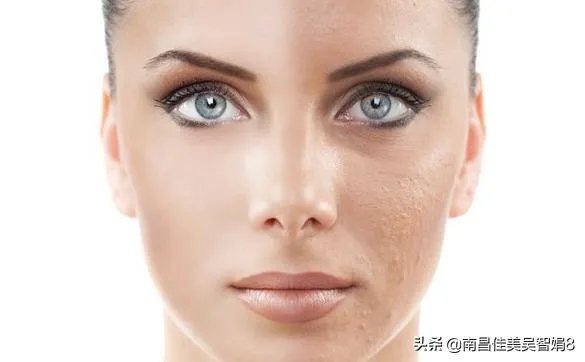 激光祛斑后注意事项？