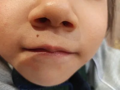 交界痣口周症状图片