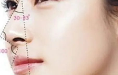 垫高鼻梁要多少钱？