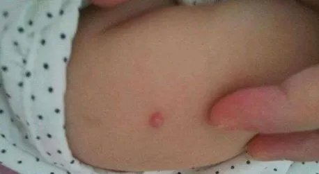 多名孩子身上出现针眼，为何作为老师都如此狠心？