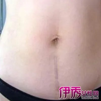 剖腹产疤痕增生图片
