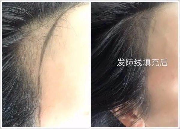 韩式半永久发际线好不好看