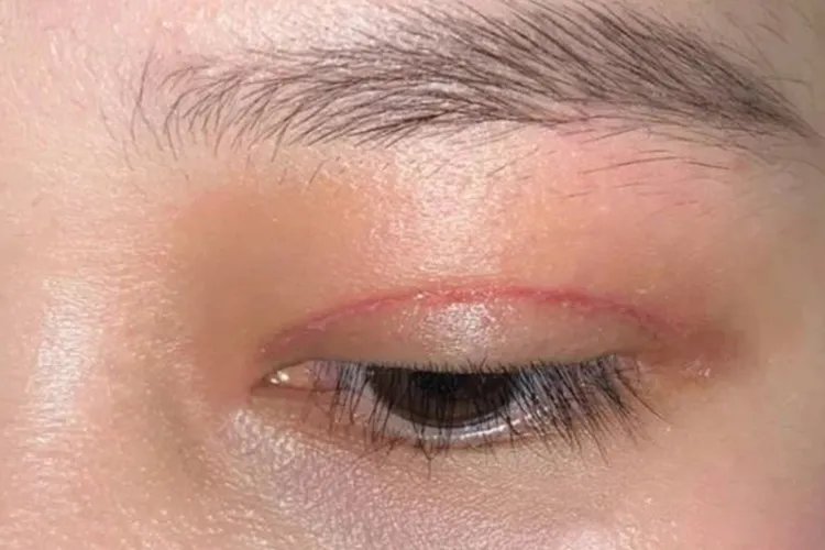 割双眼皮一到七天图片