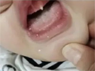 先天性外胚叶发育不良缺损图片