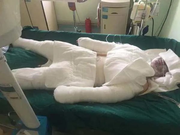 中南大学发生事故一博士生烧伤，这位博士生的伤势如何？