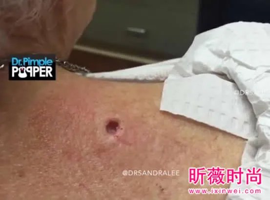 3年黑头被拔出 过程太吓人（图）