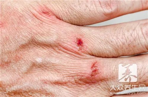 烧伤疤痕修复方法